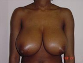 Patient # 25515 Before Photo # 1